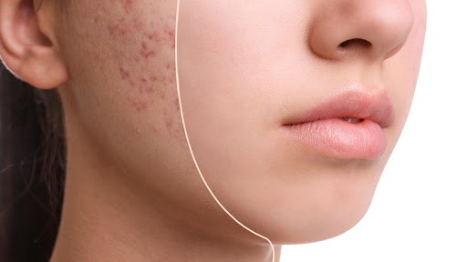  Get Rid Of Pimples In Teenagers | Skin Care Tips For Girls